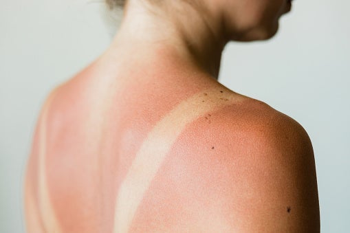 Woman's back showing sunburn